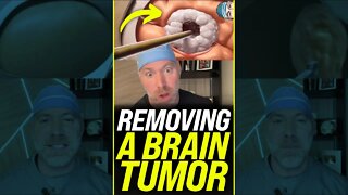 Removing a Brain Tumor 😱 #shorts