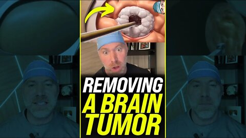 Removing a Brain Tumor 😱 #shorts