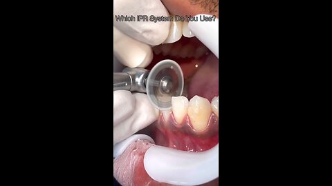 How to do internal proximal reduction | reduced teeth size|