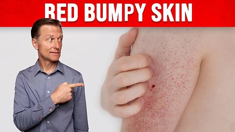 #1 Perfect Remedy for Keratosis Pilaris (CHICKEN SKIN)