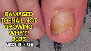 WHY ??? DAMAGED TOENAIL NOT GROWING 👣 IS IT NAIL FUNGUS??? 👣 FULL TREATMENT BY MISS FOOT FIXER