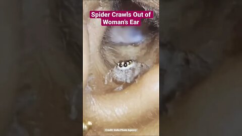 Spider Crawls Out of Woman’s Ear 🕷 #Shorts