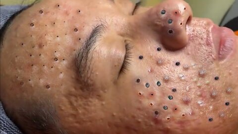 monster blackhead remove in face