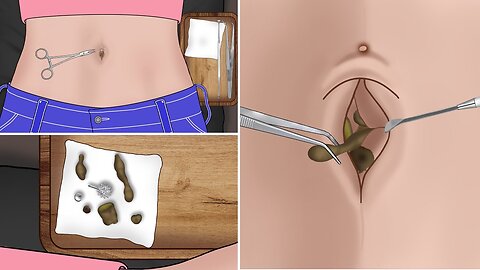 ASMR huge navel stone removal animation | let's clean your belly button