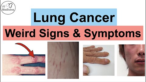 Lung Cancer Weird Signs and Symptoms | Paraneoplastic Syndromes of Lung Cancer