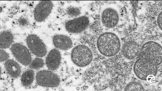WHO declares monkeypox global health emergency; how Michigan is preparing