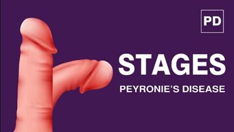 Stages of Peyronie’s Disease: Peyronies Treatment for Curvature | Mansmatters Shockwave Therapy