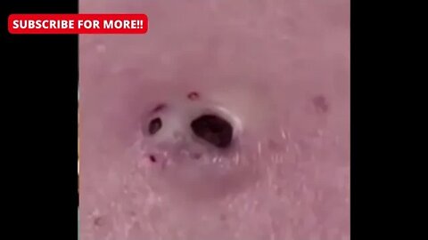 One of the biggest blackhead I've ever seen!! satisfying and relaxing!! Whitehead cravo pimple