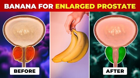 Banana For Enlarged Prostate: Can This Fruit Really Help?