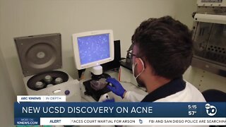 In-Depth: UCSD discovery could change acne treatment