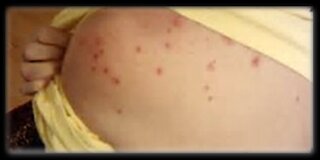 7. Rubella (measles)