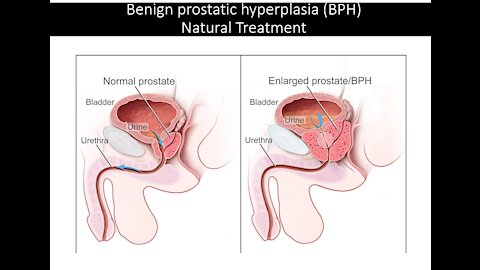 Benign Prostatic Hyperplasia - Natural Treatment