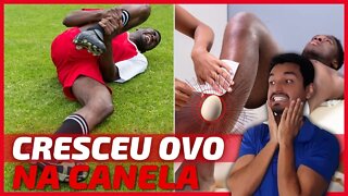 ✅Como Tratar Galo na CANELA?😱 Caroço na Canela após Pancada? 🕐Quanto TEMPO DURA um Galo na Canela?