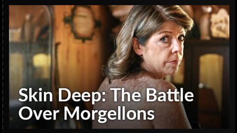 ⁣⁣SKIN DEEP- THE BATTLE OVER MORGELLONS (DOCUMENTARY VIDEO)