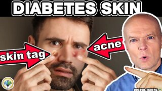 10 Alarming Skin Signs of Diabetes