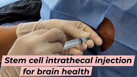 Prevent Alzheimers and Improve Brain Function with Intrathecal Stem Cell Therapy