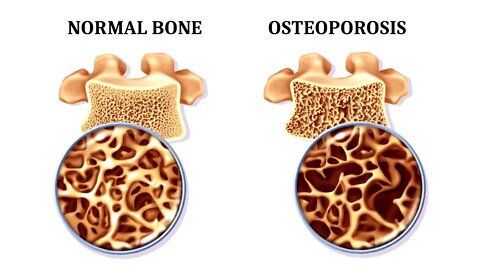 12 Foods That Fight Osteoporosis and Promote Strong Bones