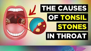 The REAL Cause of Tonsil Stones and Treatment