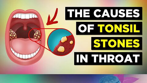 The REAL Cause of Tonsil Stones and Treatment