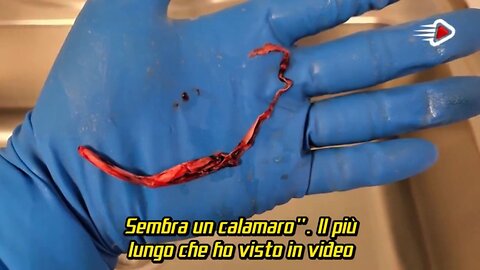 Coaguli nel sangue dei vaccinati Covid - dal film documentario DIED SUDDENLY