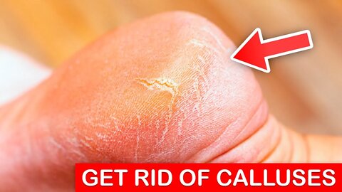 3 Fast Ways to Get Rid of Calluses