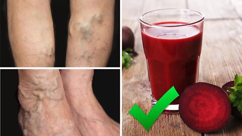Drink This Juice To Prevent and Treat Varicose Veins