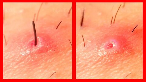 How To Get Rid Of Ingrown Hairs Naturally