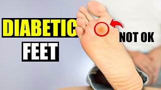 How to Take Care of Diabetic Feet & Avoid Neuropathy