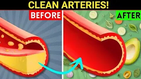 The Best Foods to Clean Arteries & Reverse Plaque, Prevent Heart Attack & Stroke
