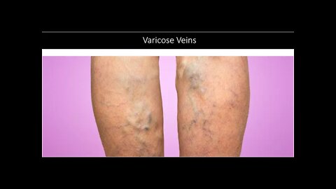 Varicose Veins - Natural Treatment