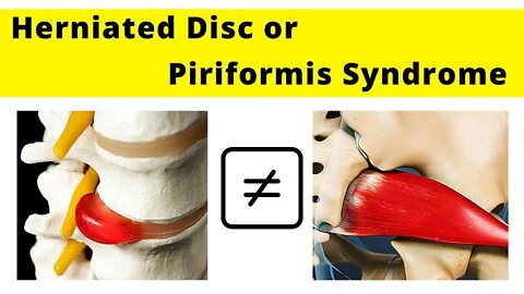 Piriformis syndrome exercises