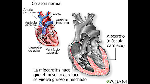 MIOCARDITIS - uno de los primeros efectos directos de las vacunas Covid 19