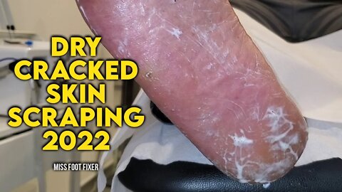 Dry Cracked Skin Scraping [ 2022] by famous foot doctor miss foot fixer