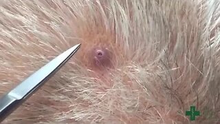 Removal of a small pilar cyst using a punch biopsy