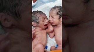 Preterm twins _ How one baby sleeps and other tries to awake him ....... #shorts