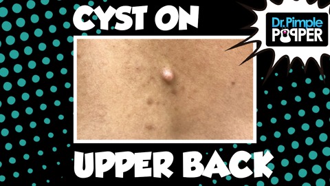 A Cyst on Top!