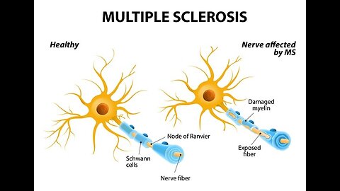 Unraveling Multiple Sclerosis: Types and Symptoms