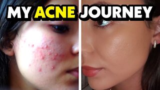 HOW I CURED MY ACNE WITH A MAGIC PILL💊 | Hormonal acne natural treatment