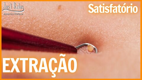 Relaxante e Satisfatório Remoção de Comedões Asmr - Just Relax | Apenas Relaxe