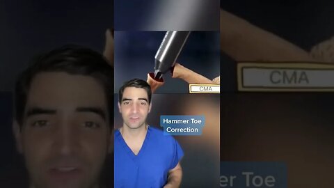 Hammer toe correction