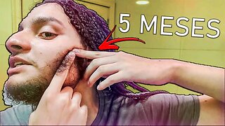 5 MESES USANDO MINOXIDIL