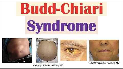 “Liver Disease From Blood Clot” (Budd-Chiari Syndrome) Risk Factors, Symptoms, Diagnosis, Treatment