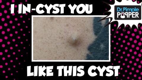 I Incyst you like this cyst!