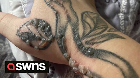 UK mum's tattoo erupts in painful warts due to rare reaction to pregnancy