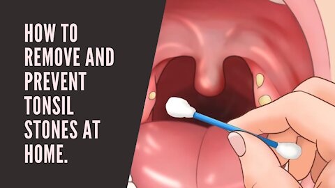 How To Remove and Prevent Tonsil Stones At Home.