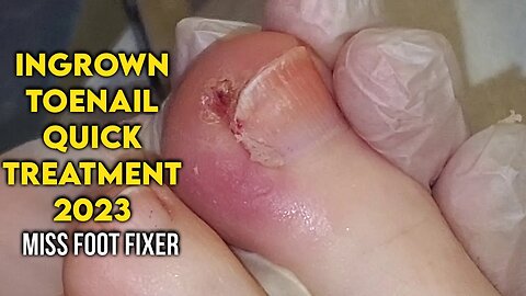 Ingrown Toenail Quick Treatment 2023 [ Ingrown nail removal ] by Foot Doctor Miss Foot Fixer