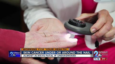 Checking your fingernails for signs of Melanoma