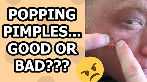 Popping Pimples - The Things You Should Know!!