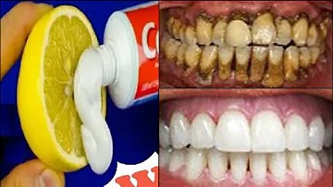 Magical Teeth Whitening Remedy, Get whiten Teeth at home in one week