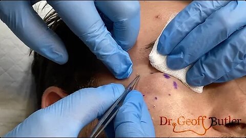 Removal of a cyst under the right eye